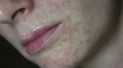 Demodekoza: šta su, simptomi i tretman