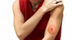 Liječenje krpeljnog rorelioze